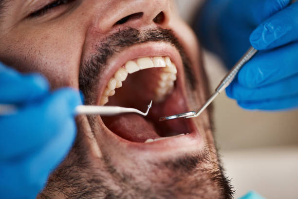 Best Emergency Dentist for Lost Fillings or Crowns in Ringgold, GA